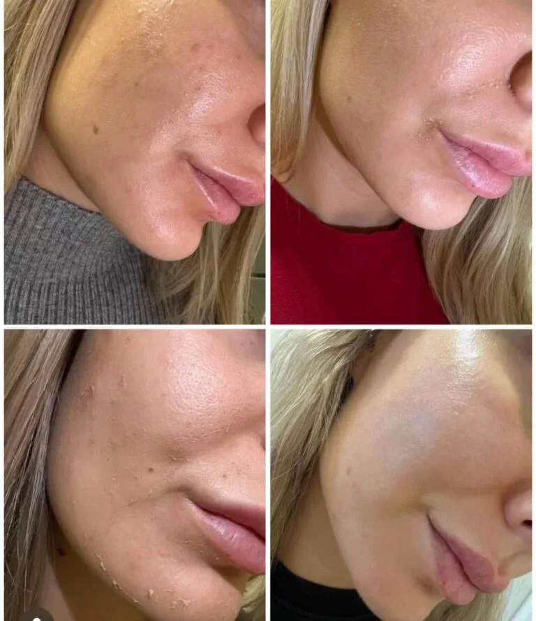 chemicky peeling2